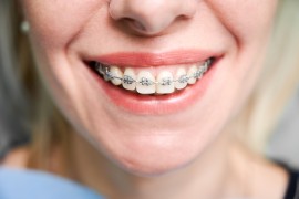 Get Braces in Singapore – Cost-Effective Solutions, Bukit Timah Estate, Singapore