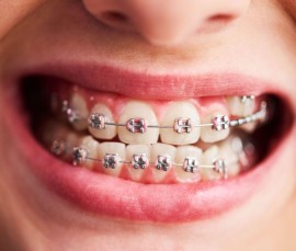 Orthodontics Braces - Straighten Your Teeth Today!, Bukit Timah Estate, Singapore