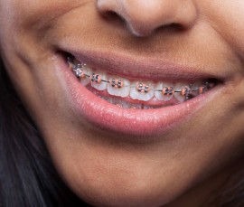 Orthodontics Braces - Straighten Your Teeth Today!, Bukit Timah Estate, Singapore