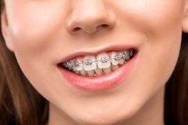 Braces Installment Plans – Pay in Easy Steps for a, Bukit Timah Estate, Singapore