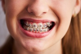 Braces Installment Plans – Pay in Easy Steps for a, Bukit Timah Estate, Singapore