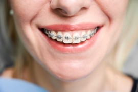 Braces Installment Plans – Pay in Easy Steps for a, Bukit Timah Estate, Singapore