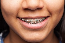 Braces Installment Plans – Pay in Easy Steps for a, Bukit Timah Estate, Singapore