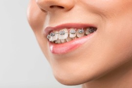 Braces Installment Plans – Pay in Easy Steps for a, Bukit Timah Estate, Singapore