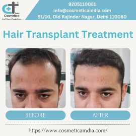 Hair Transplant Treatment, New Delhi, India